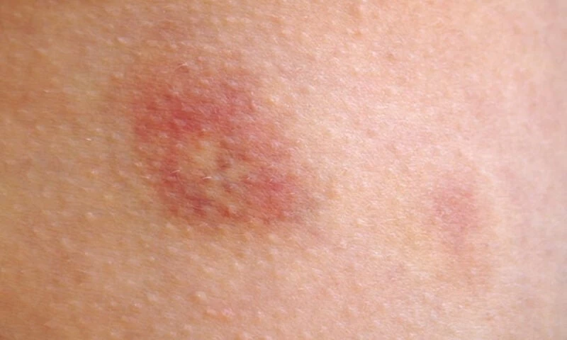 Σημάδια στο δέρμα και τι δείχνουν για την υγεία (εικόνες)